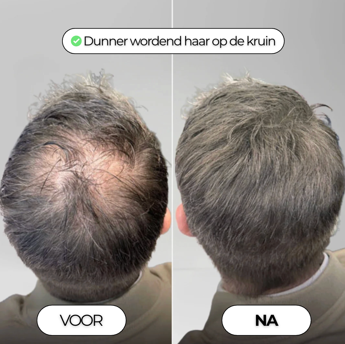 Densiva Hair Restore - Compleet Haarherstel Systeem