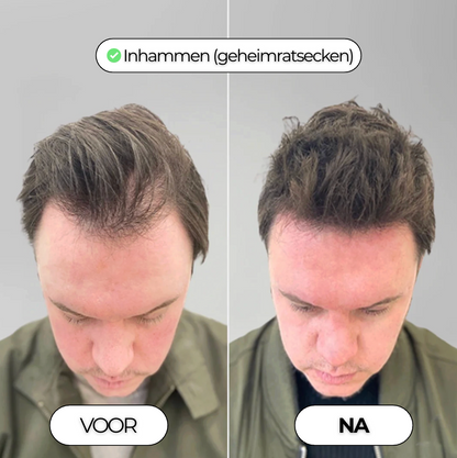 Densiva Hair Restore - Compleet Haarherstel Systeem
