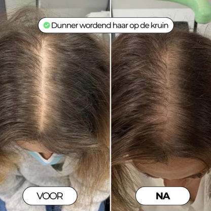Densiva Hair Restore - Compleet Haarherstel Systeem