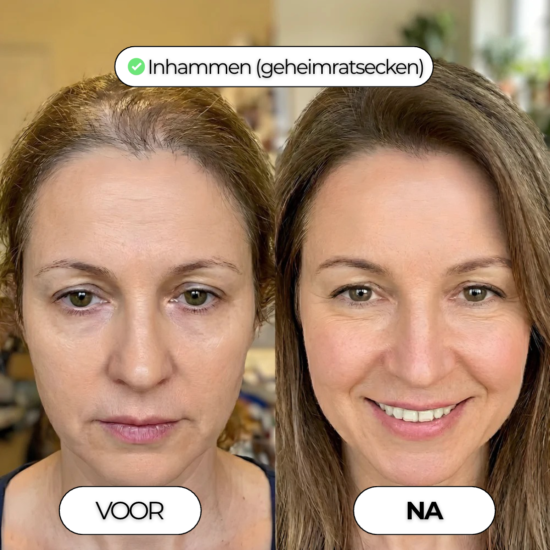 Densiva Hair Restore - Compleet Haarherstel Systeem