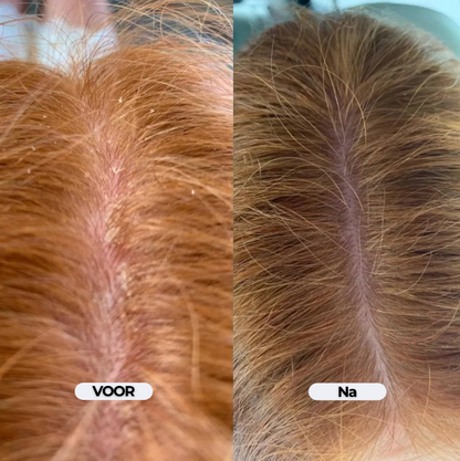 DermaCalm Repair - Kalmerende verzorging bij jeuk en schilfers op de hoofdhuid